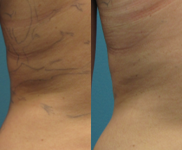 Tattoo Removal before and after photo