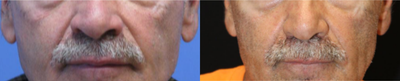 Bellafill before and after photo