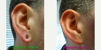 Earlobe Repair before and after photo