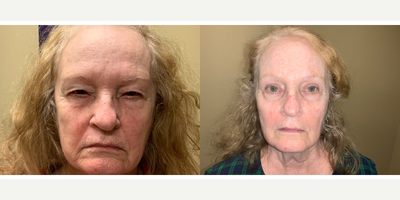 Eyelid Surgery before and after photo