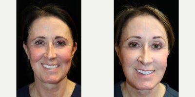 Facelift before and after photo