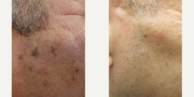 Fractional Laser before and after photo