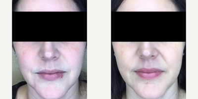 Laser Resurfacing before and after photo