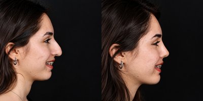 Laser Resurfacing before and after photo