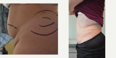 Mini Tummy Tuck before and after photo