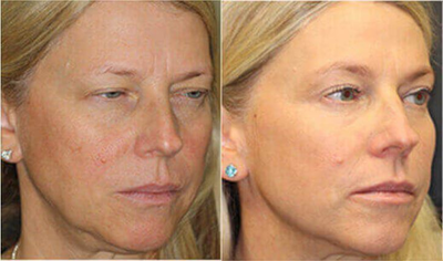 Brow Lift before and after photo