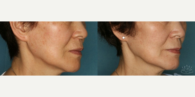 Clear and Brilliant before and after photo