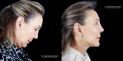 Deep Plane Facelift before and after photo