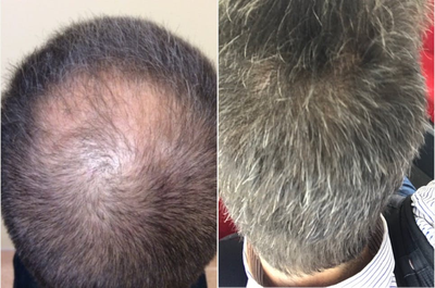 Hair Loss Treatment before and after photo