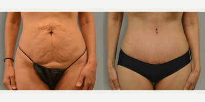 Tummy Tuck before and after photo
