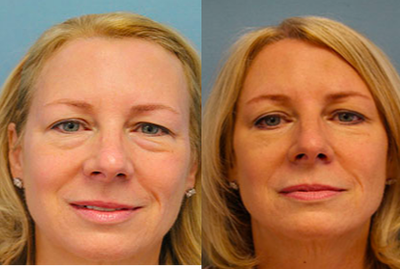 Eyelid Surgery before and after photo