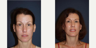 Mini Facelift before and after photo