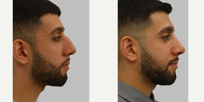 Rhinoplasty before and after photo