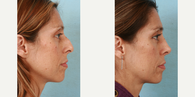 Rhinoplasty before and after photo