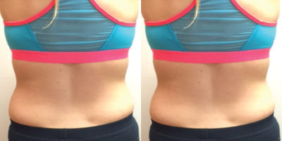 Venus Legacy before and after photo