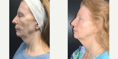 Botox before and after photo