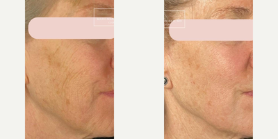 CO2 Laser before and after photo