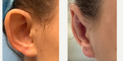 Ear Surgery before and after photo