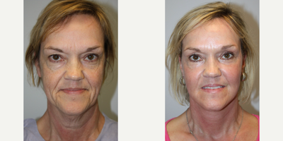 Facelift before and after photo