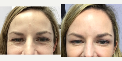 Jeuveau before and after photo