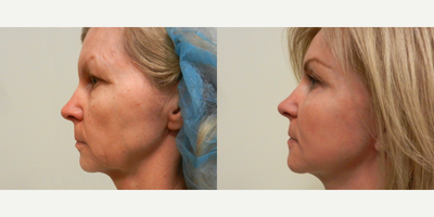 Laser Resurfacing before and after photo