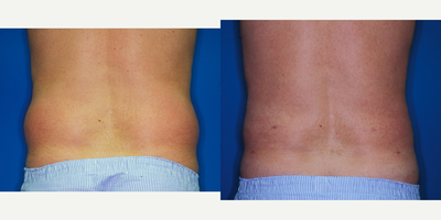 Liposuction before and after photo