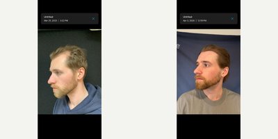 NeoGraft before and after photo