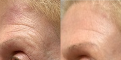 Nonsurgical Facelift before and after photo