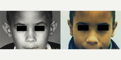 Ear Surgery before and after photo