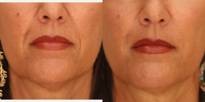 Juvederm before and after photo