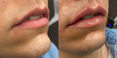 Juvederm before and after photo