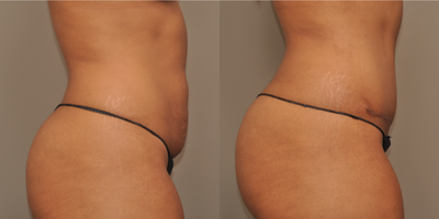 Mommy Makeover before and after photo