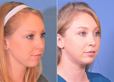 Rhinoplasty before and after photo