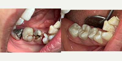 Dental Crown before and after photo