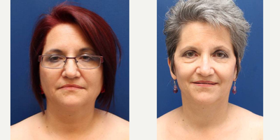 Facelift before and after photo