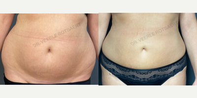 Liposuction before and after photo