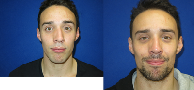 Rhinoplasty before and after photo