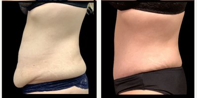 Tummy Tuck before and after photo