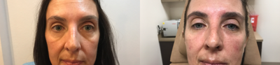 Belotero before and after photo