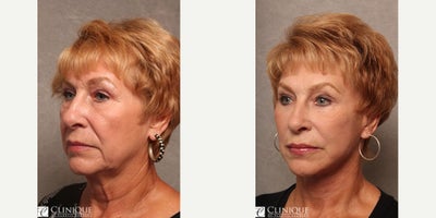 Facelift before and after photo