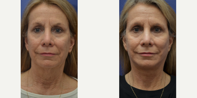 Neck Lift before and after photo