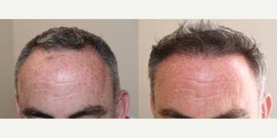 FUE Hair Transplant before and after photo