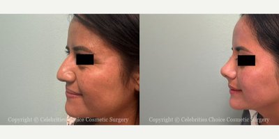 Rhinoplasty before and after photo