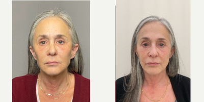 Cheek Lift before and after photo