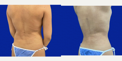 Liposculpture before and after photo