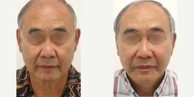 MACS Facelift before and after photo