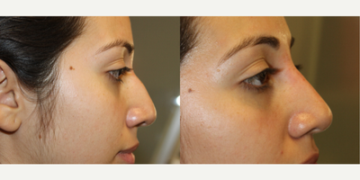Restylane before and after photo