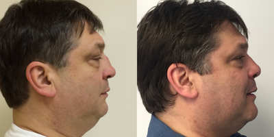 Facial Reconstructive Surgery before and after photo