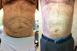 Liposuction before and after photo