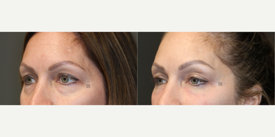 Restylane before and after photo